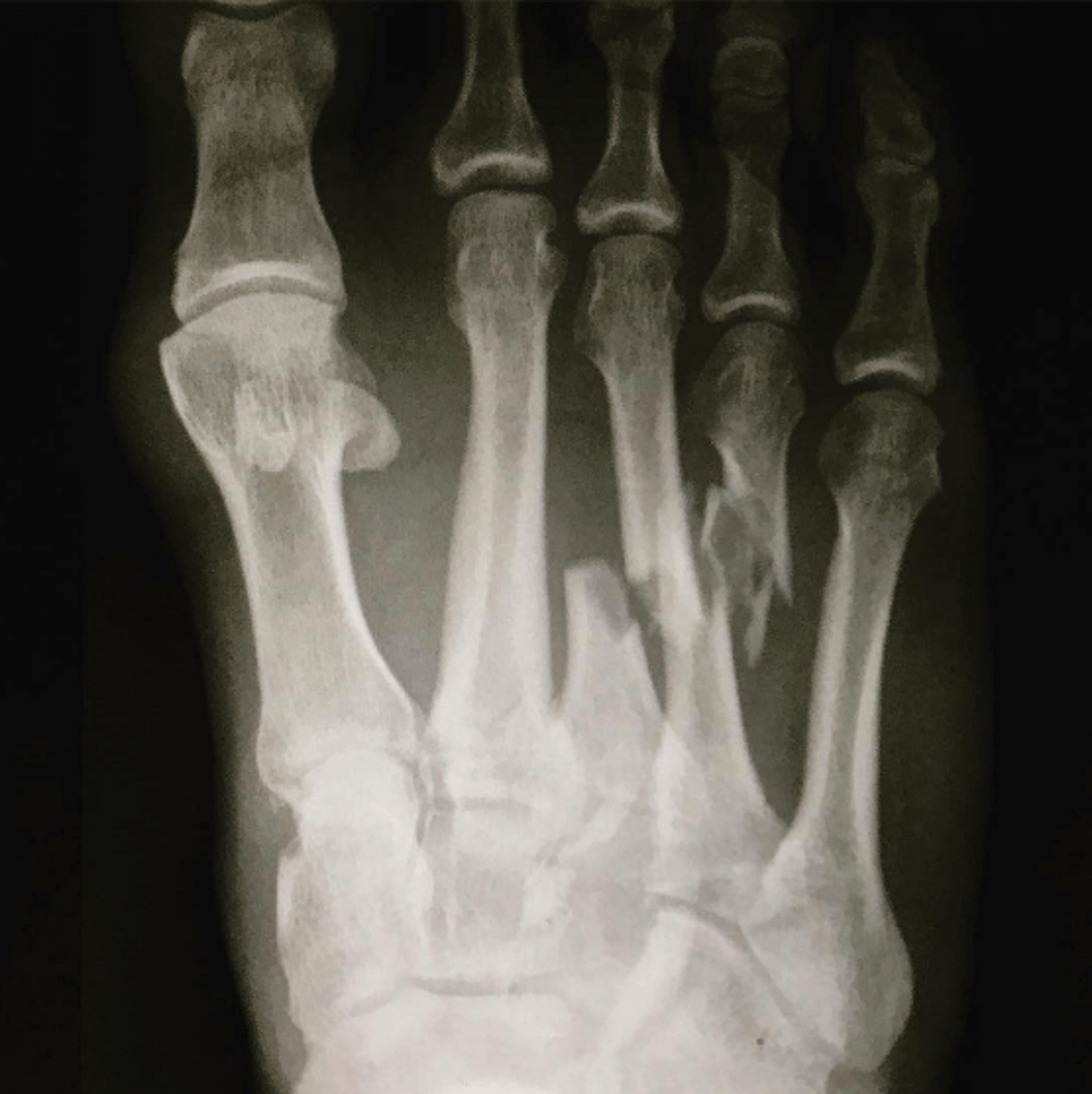 Blisters and breakages: Even professional athletes aren't immune